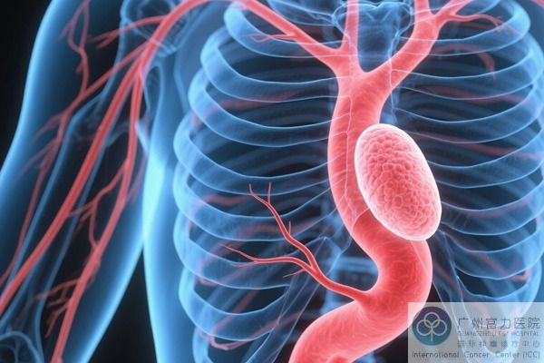 肠癌.jpg